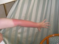 sunburnt-arm-1.jpg