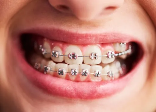 shot-child-s-teeth-with-braces_329181-17722.webp
