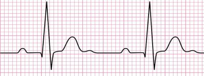 Normal ECG Trace.jpg
