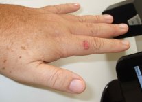 Burned finger.jpg