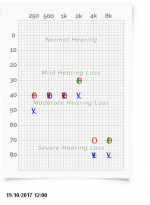 Audiogram 19-10-2017 12_00 four days after ear canal cleaning.PNG