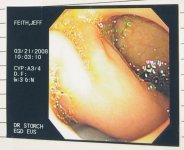 tumor1.jpg